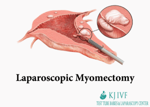 Laparoscopic Myomectomy Treatment In Delhi Faridabad India