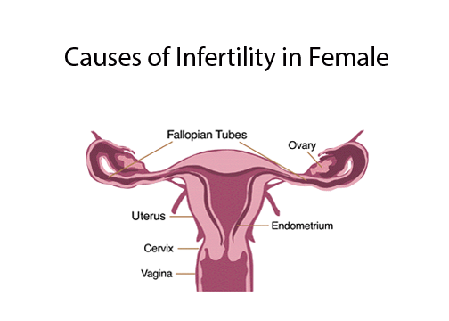 Causes-of-infertility-in-female