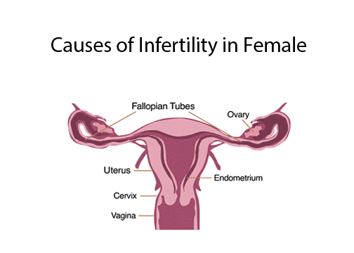 Causes of Infertility in Female - Female Infertility Delhi