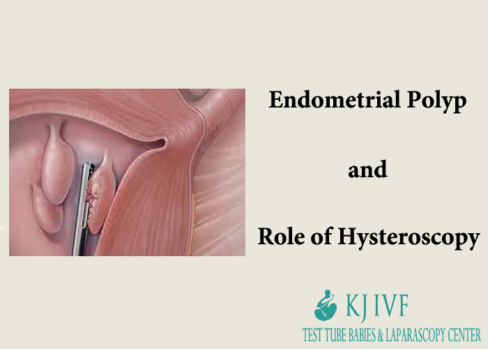 Endometrial-Polyps
