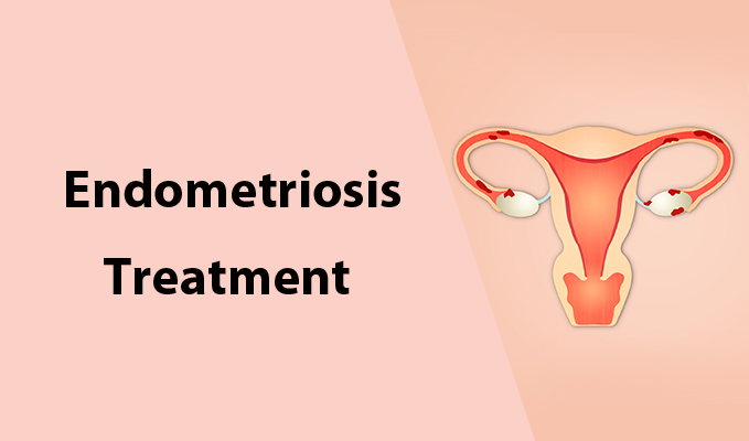 Endometriosis Treatment