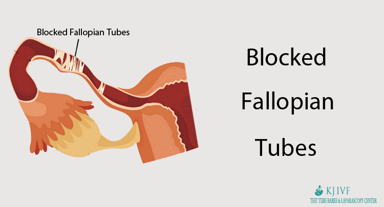 Blocked Follpian Tubes