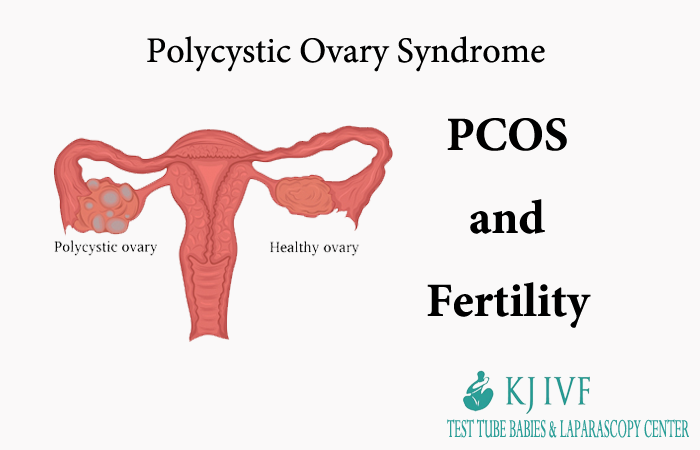 pcos and fertility