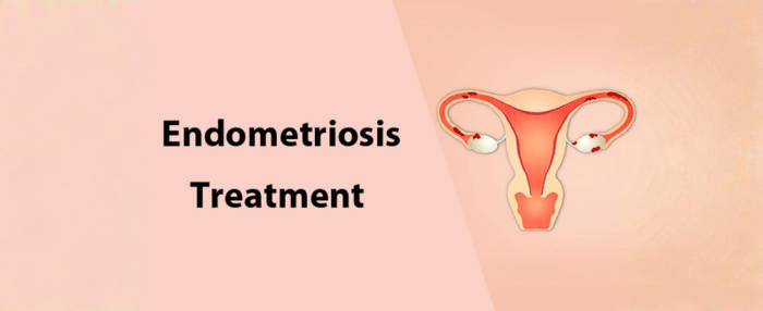 Endometriosis Treatment