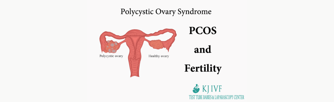 PCOS and Fertility