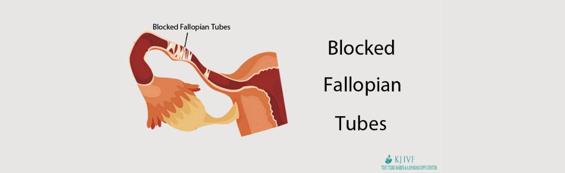 Blocked Fallopian Tubes