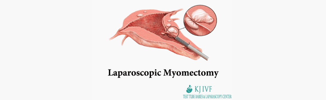 Laparoscopic Myomectomy
