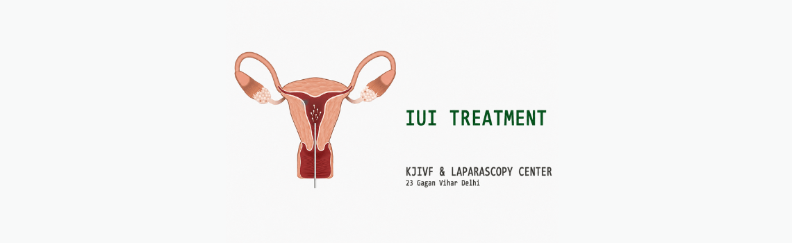 IUI Treatment